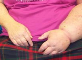 Lymphoedema